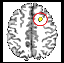 Image of MRI scan of brain with area affected my meditation highlighted in yellow.