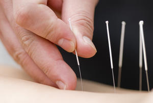 Acupunture needles