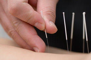 acupuncture needles going into skin