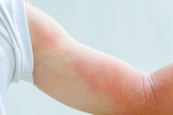 close up of a red rash on an arm