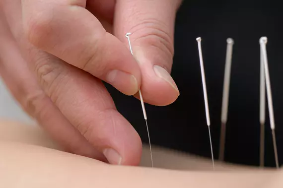 Acupunture on a person's skin.