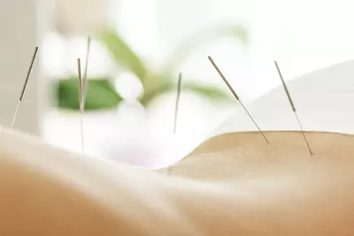 acupuncture needles in someone's back