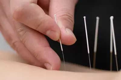 practicing acupuncture