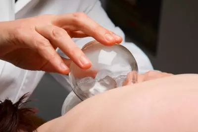 Person receiving cupping therapy.