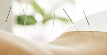 acupuncture needles in someone's back