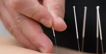 person inserting acupuncture needles
