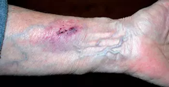 Damaged skin at the wrist.