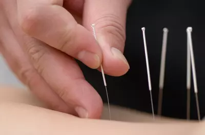 Acupuncture treatment